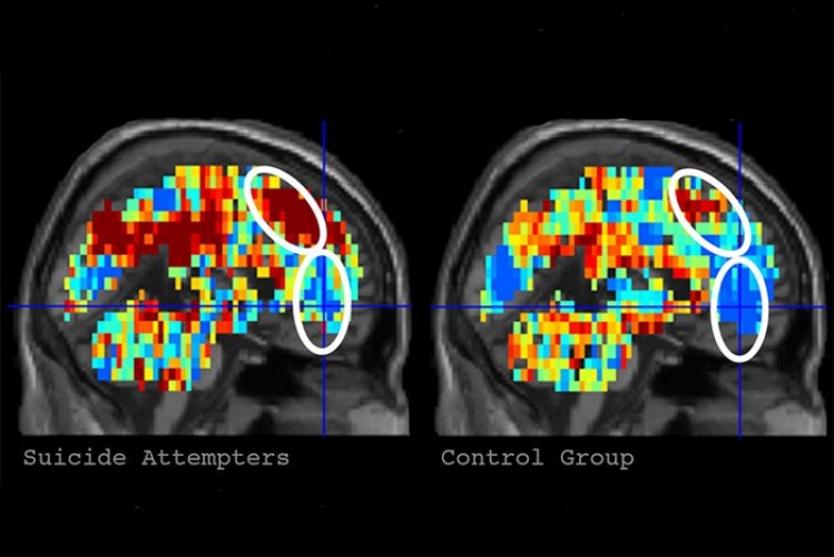 Alzheimer xəstəliyinin aşkar edilməsinin asan üsulu tapılıb